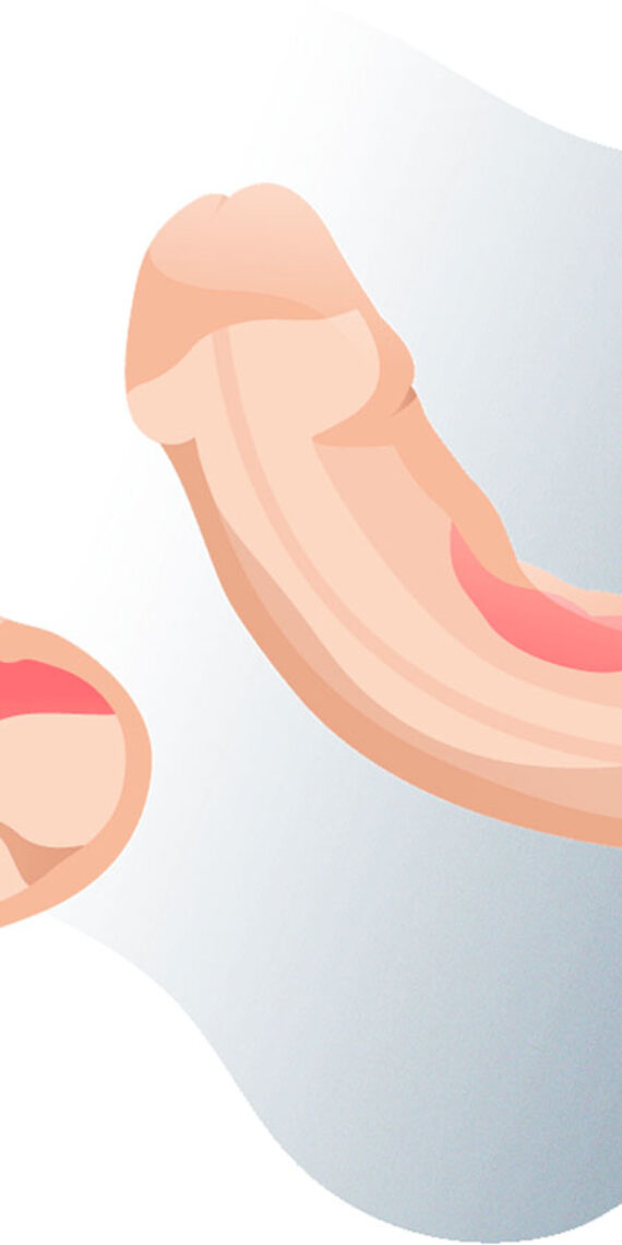 tratamiento enfermedad de peyronie valencia